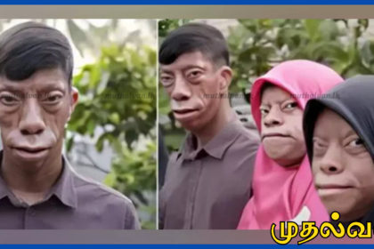 இந்தோனேசியாவில் ஒரே நபருக்கு பகலில் மனிதன், இரவில் பல்லி போல முகமாற்றம்